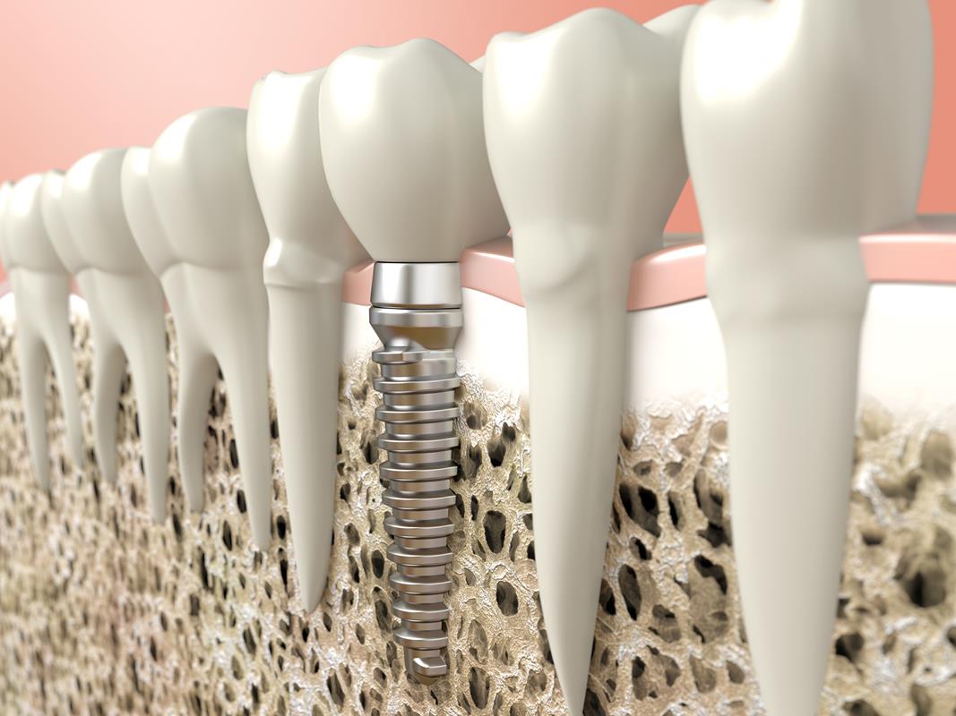 Dental Implants  Cape Girardeau, MO 